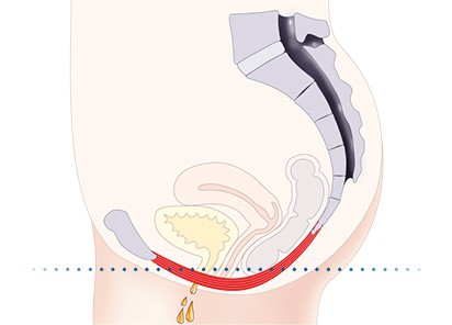 Pelvic-Floor Muscle Repair 5 Pelvic floor muscles Warwick